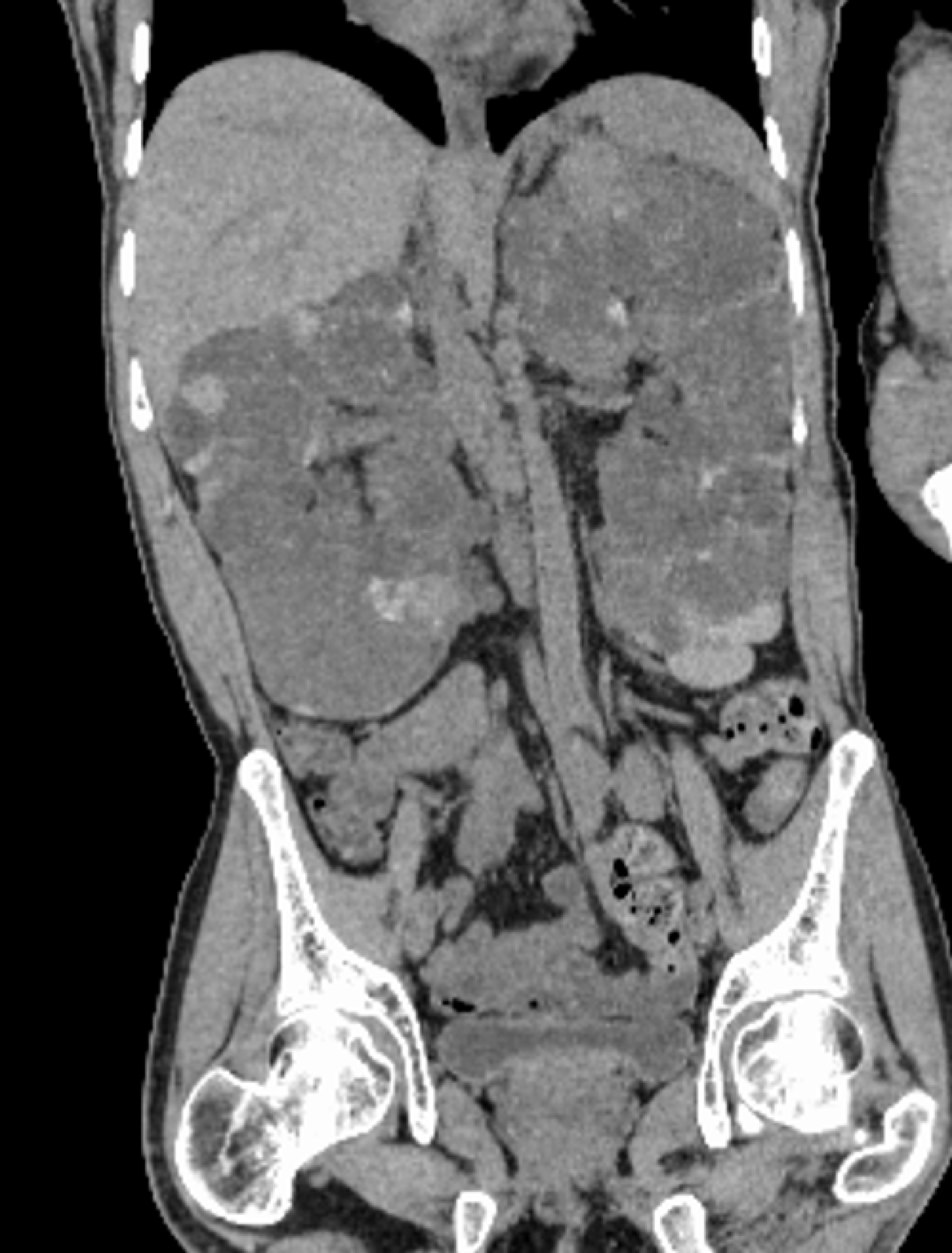 Kidney transplantation after chronic active Epstein-Barr virus infection remission