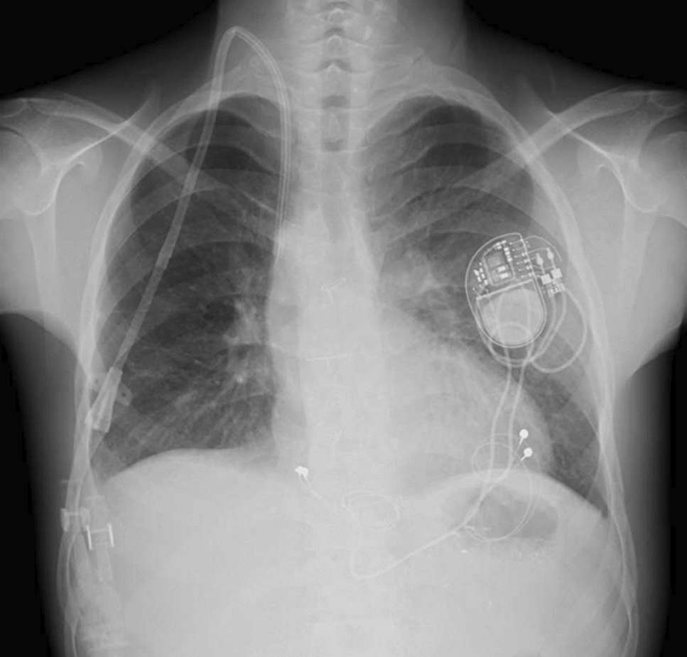 Successful transition from long-term peritoneal dialysis to intermittent hemodialysis in a patient with Fontan circulation