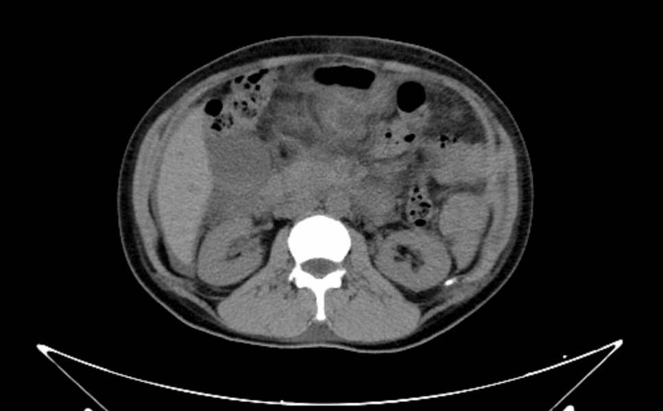 Acute kidney injury requiring temporary hemodialysis due to HELLP syndrome: a case report