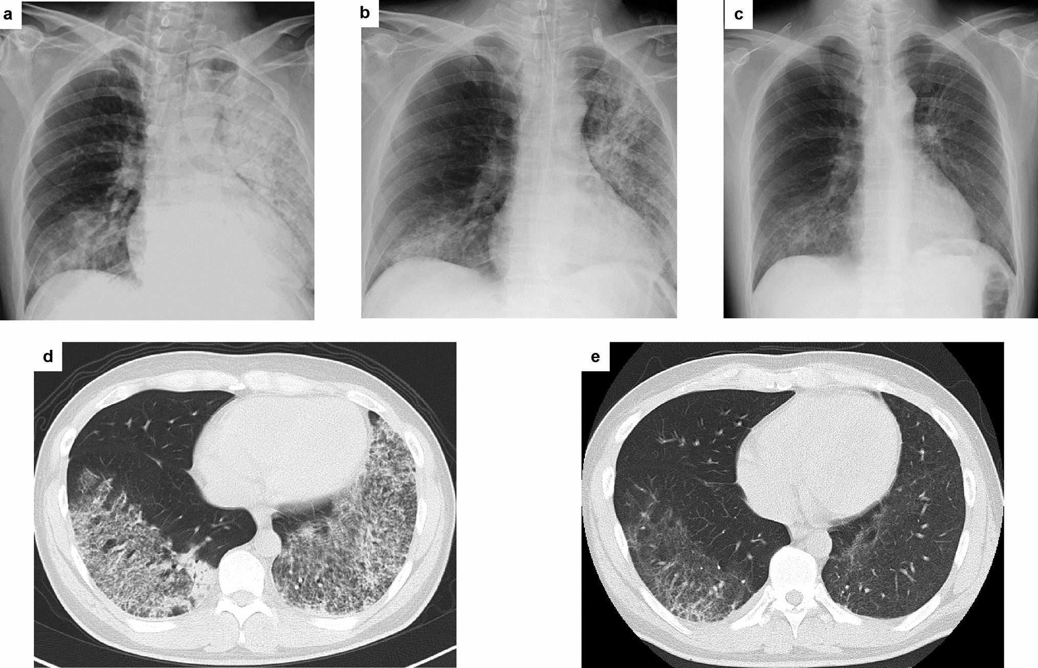 Avacopan for severe pulmonary hemorrhage requiring extracorporeal membrane oxygenation in a patient with MPO-ANCA positive vasculitis