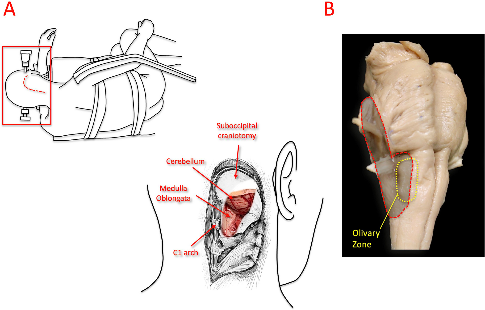 Anatomical and quantitative analysis of safe entry zones to the lower brainstem through the far-lateral approach