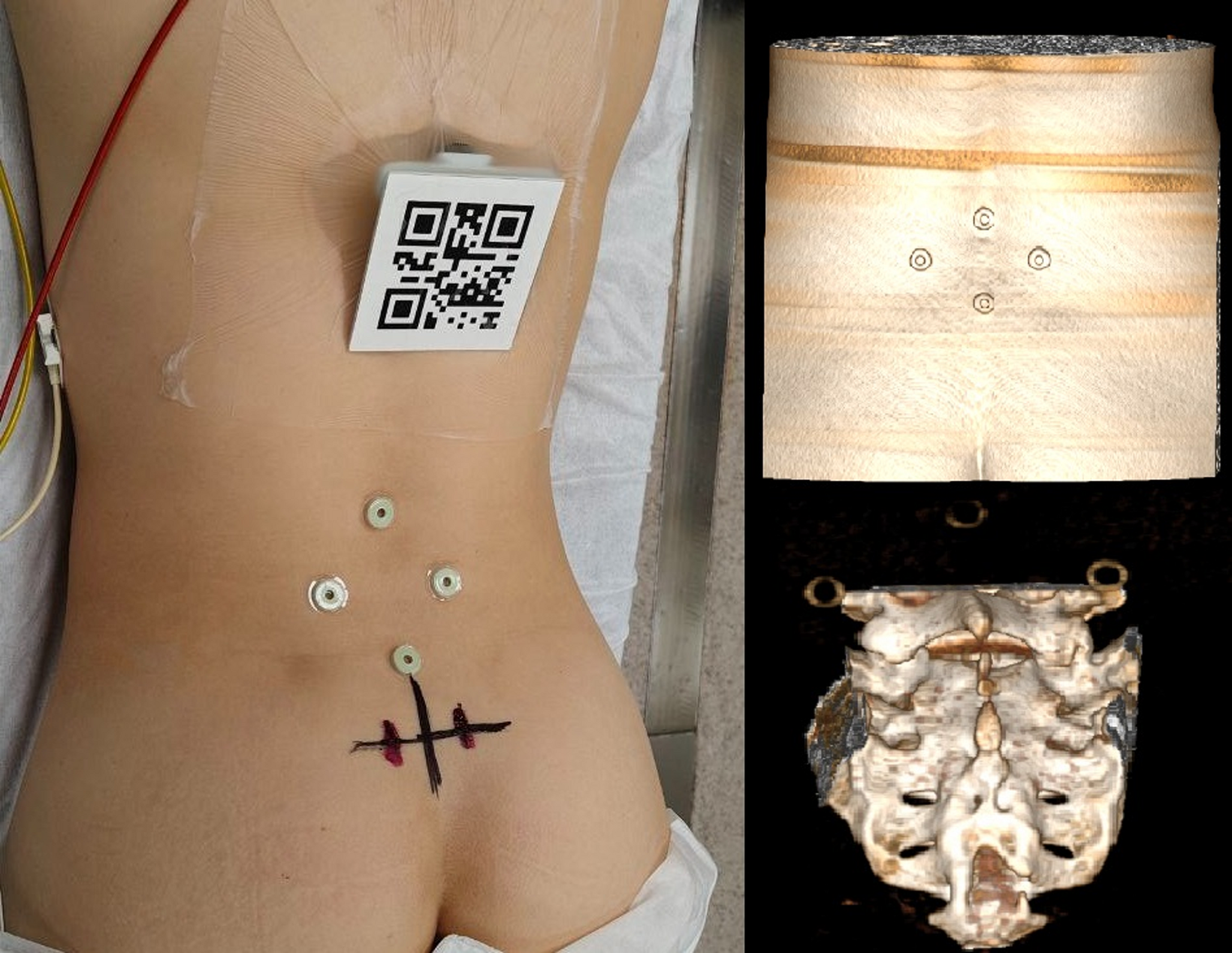 Pilot study on the application of augmented reality navigation for sacral neuromodulation and sphenopalatine ganglion stimulation