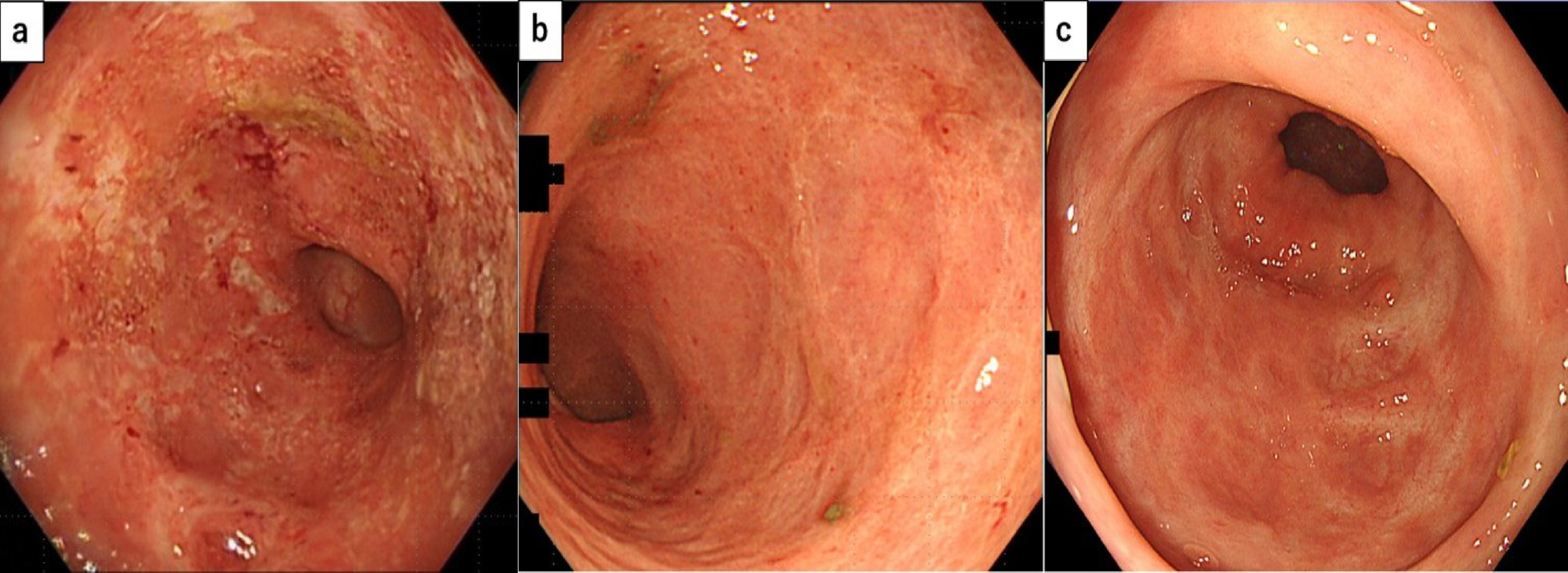 Diffuse duodenitis in a patient with ulcerative colitis who was successfully treated with upadacitinib