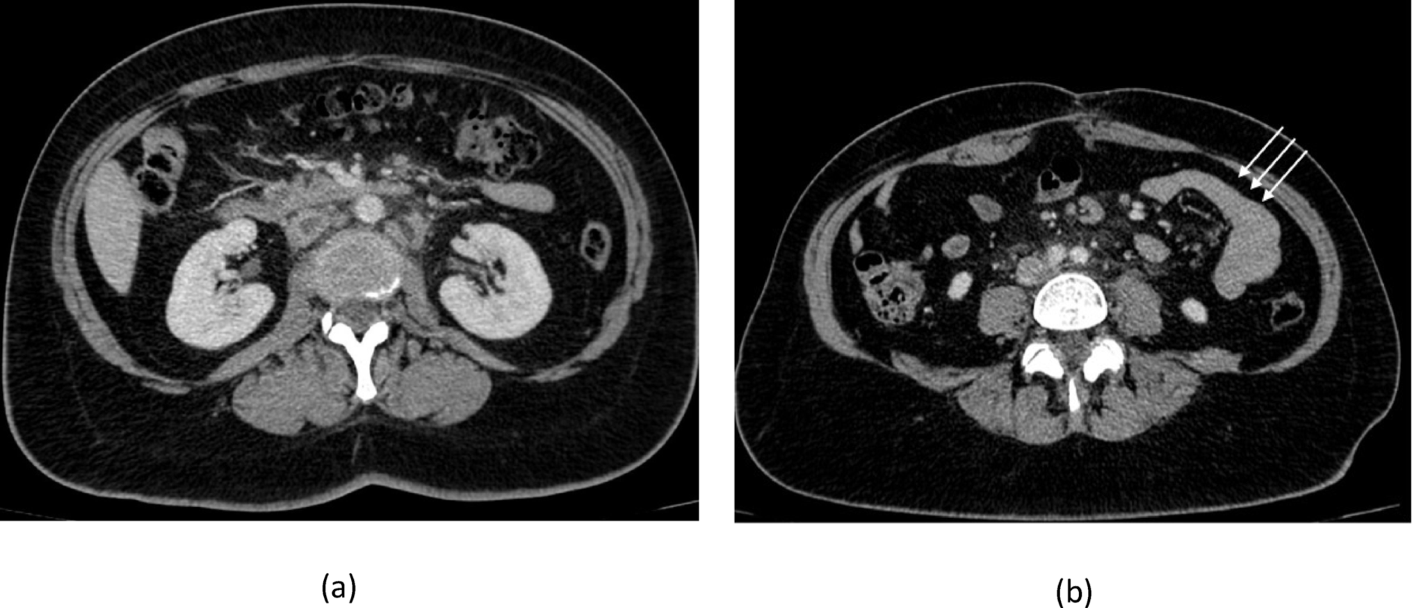 Beyond the Flare: A Case of Disseminated Tuberculosis and Thrombosis Masquerading as IBD Exacerbation