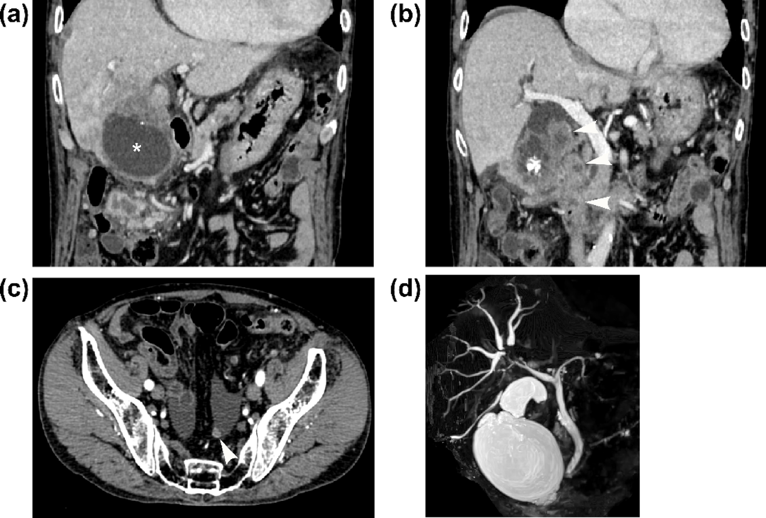 Advanced poorly differentiated gallbladder carcinoma with focal poorly cohesive and signet-ring cell features