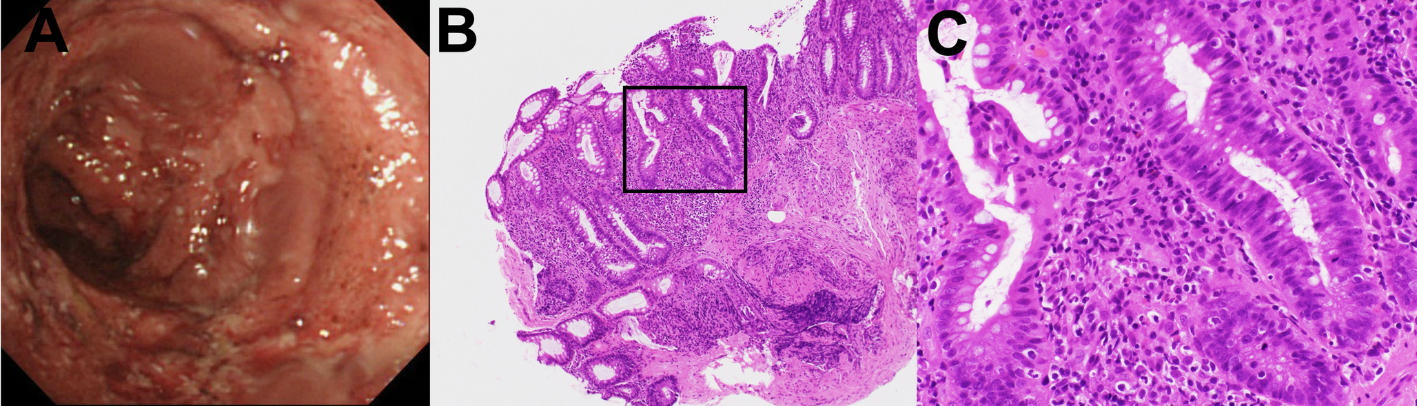 Histopathological predictor of response to mirikizumab in active ulcerative colitis