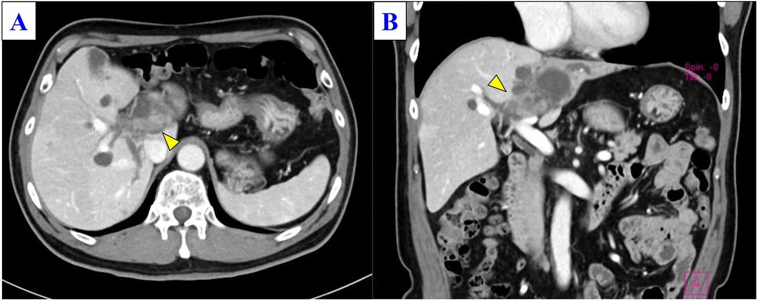 Long-term survival after multidisciplinary treatment including durvalumab for recurrent perihilar cholangiocarcinoma