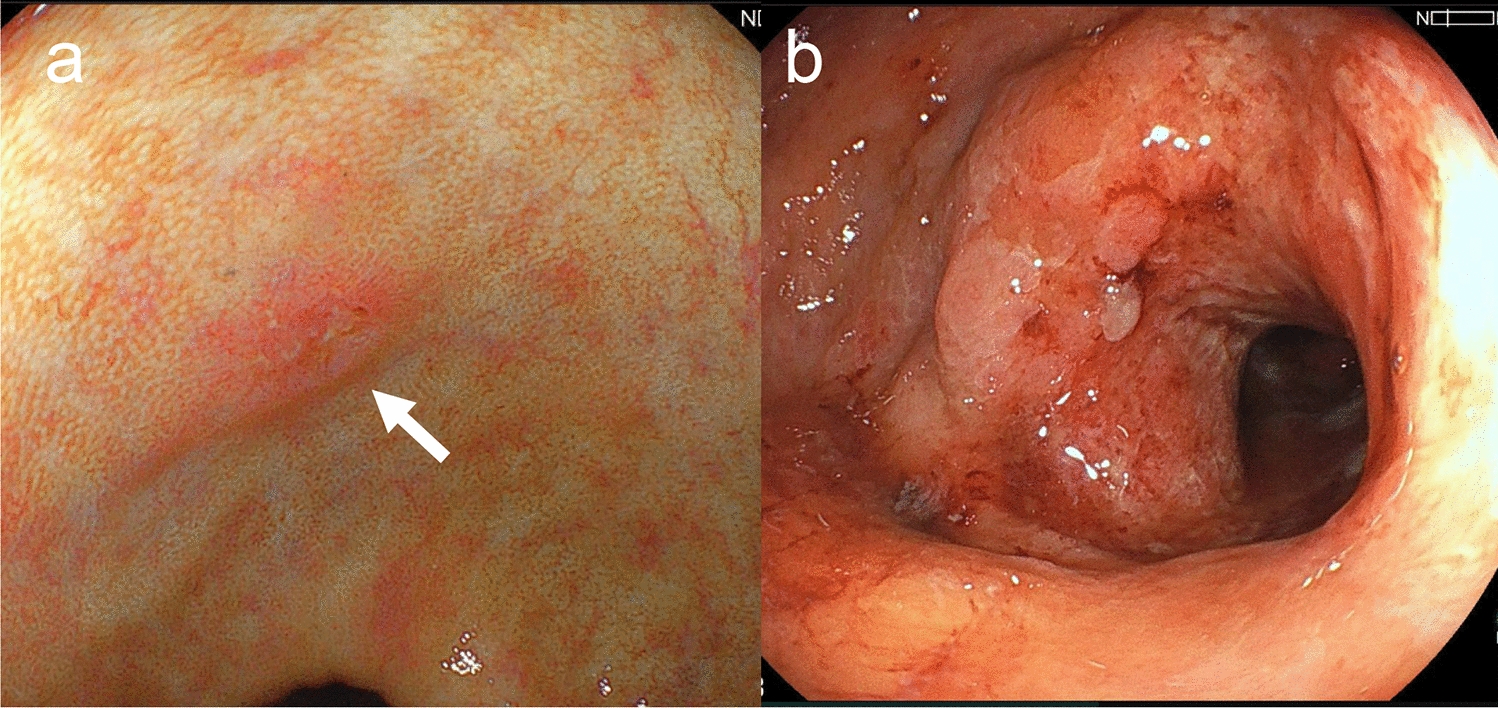 Classic hodgkin lymphoma associated with Epstein–Barr virus reactivation during vedolizumab therapy for ulcerative colitis
