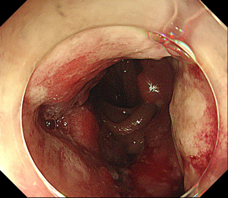 Robot-assisted anterior resection for rectal cancer in a patient with Leriche syndrome: a case report