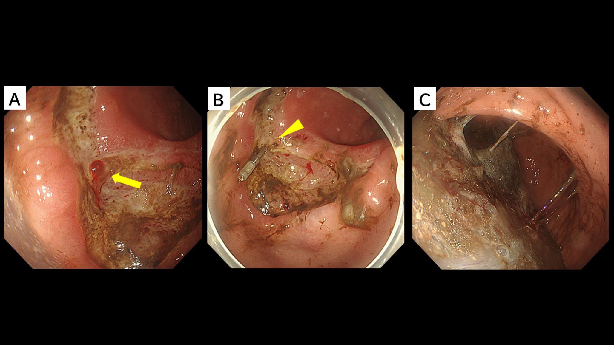 Single-session endoscopic removal of a giant gastric diospyrobezoar in a remnant stomach using direct Coca-Cola injection and mechanical fragmentation