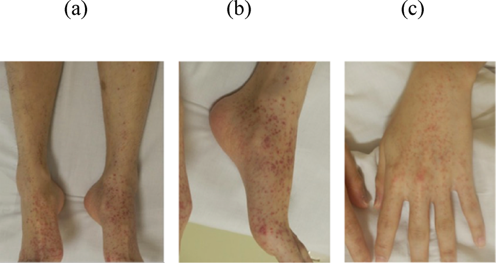A case of IgA vasculitis developing in a patient with Crohn’s disease treated with adalimumab