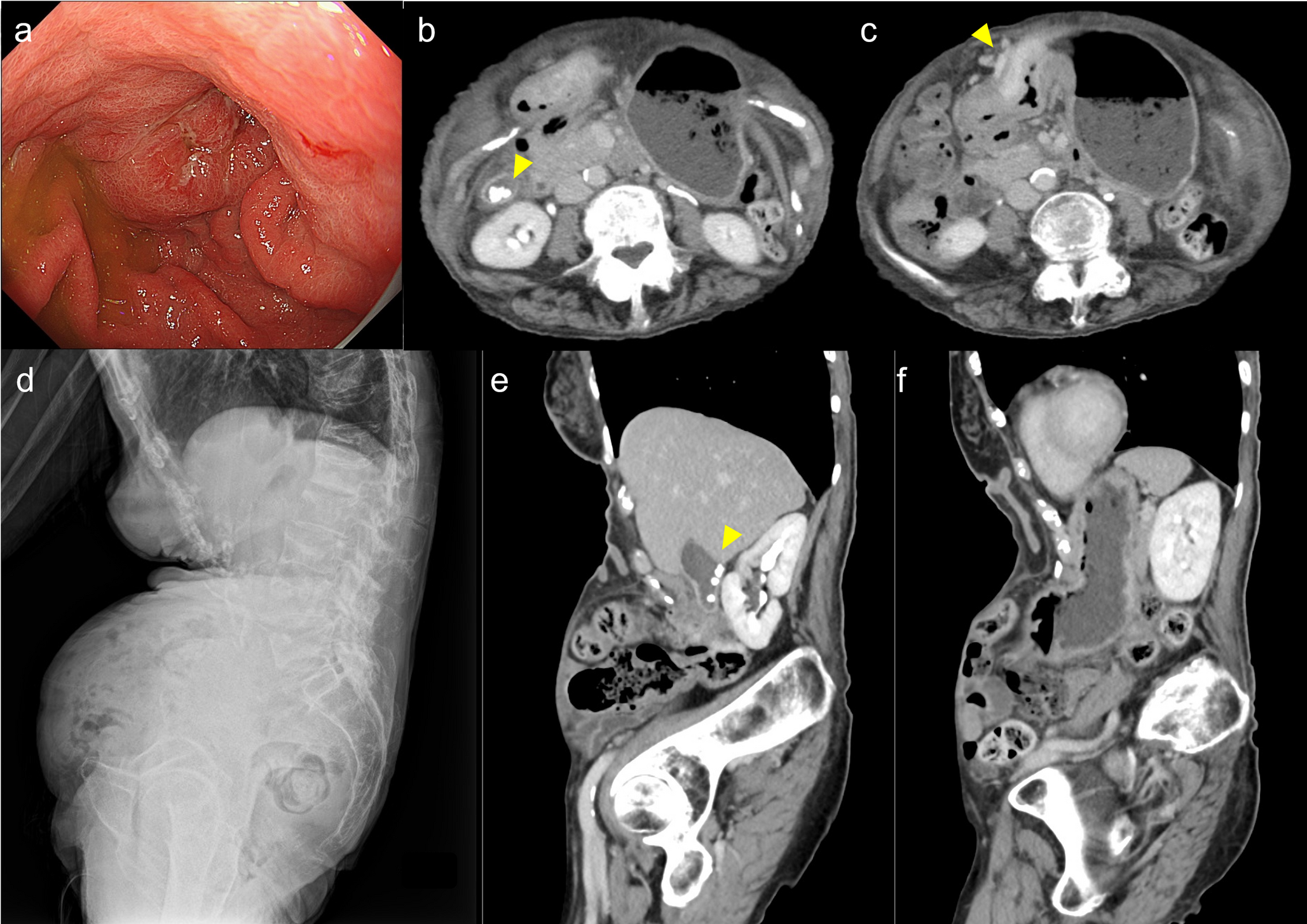 A case of robotic-assisted distal gastrectomy and cholecystectomy for gastric cancer and cholelithiasis in a patient with severe kyphosis
