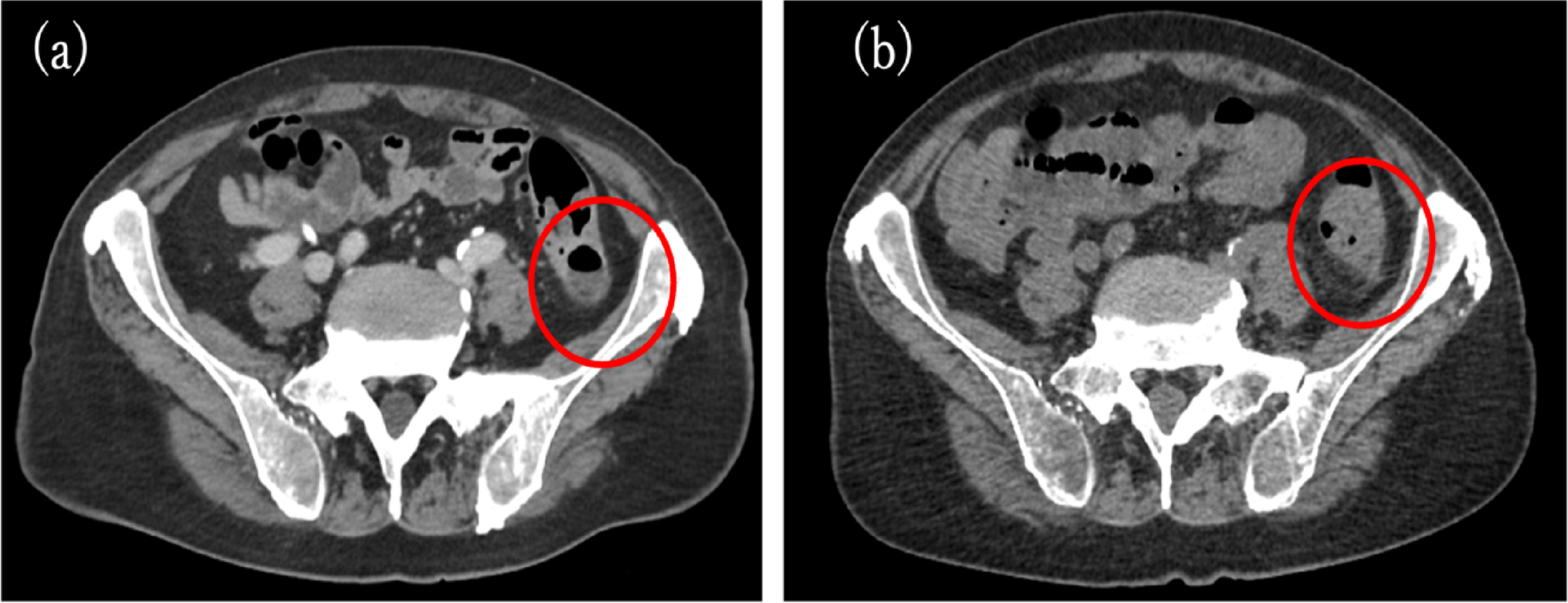 A case of intestinal tumor formation during gilteritinib therapy that resolved without discontinuing the drug
