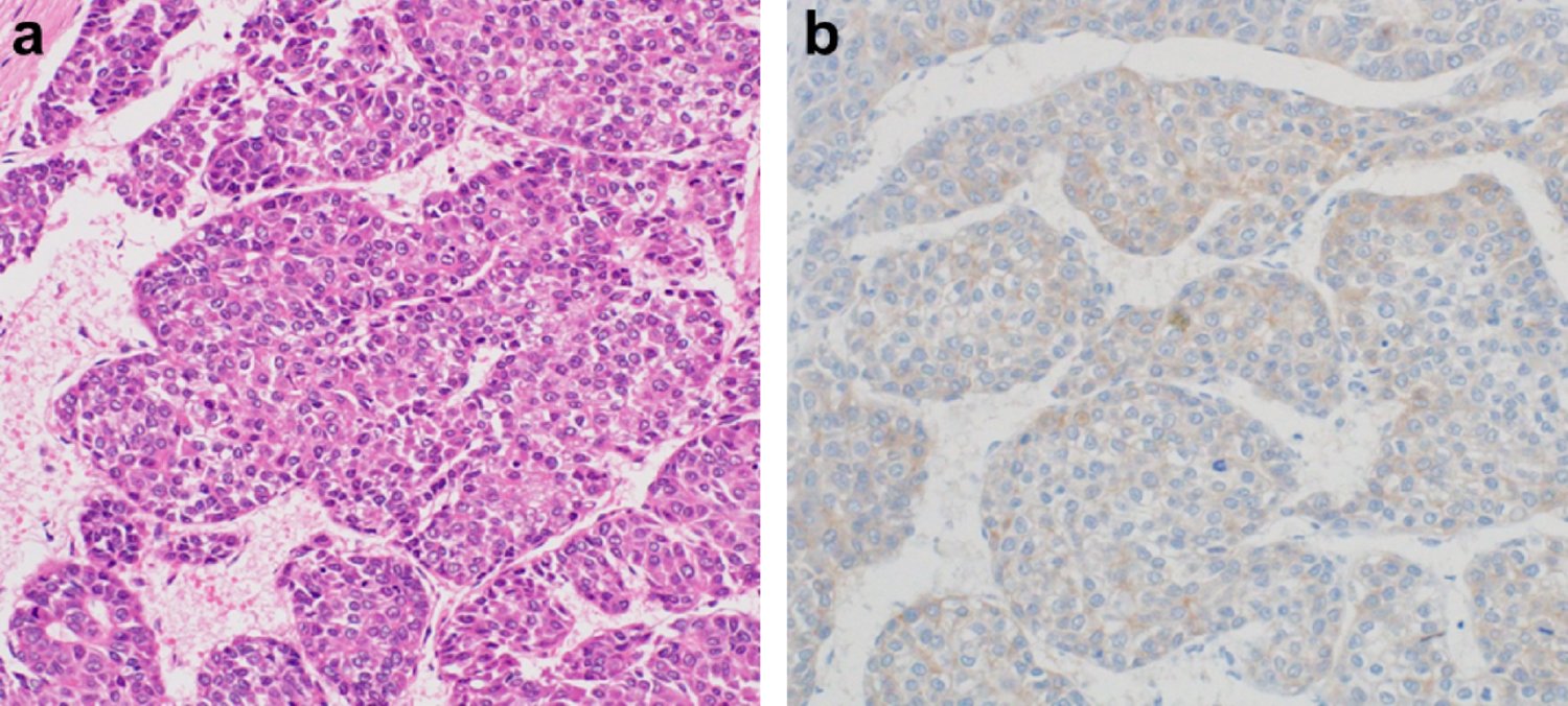 A case of complete remission with durvalumab-cabozantinib sequential therapy for advanced hepatocellular carcinoma