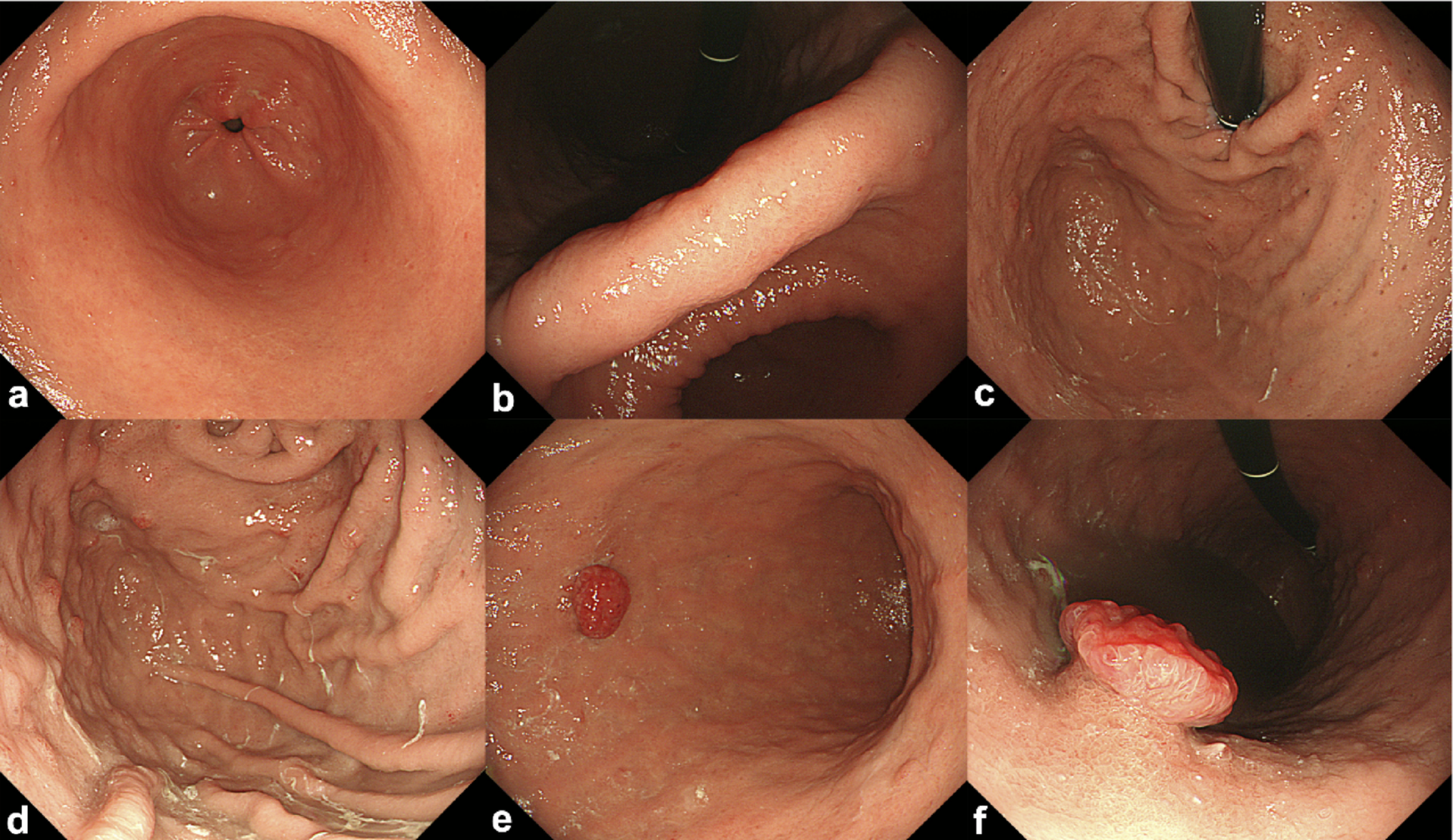A case of gastric neuroendocrine tumor with an unusual morphology