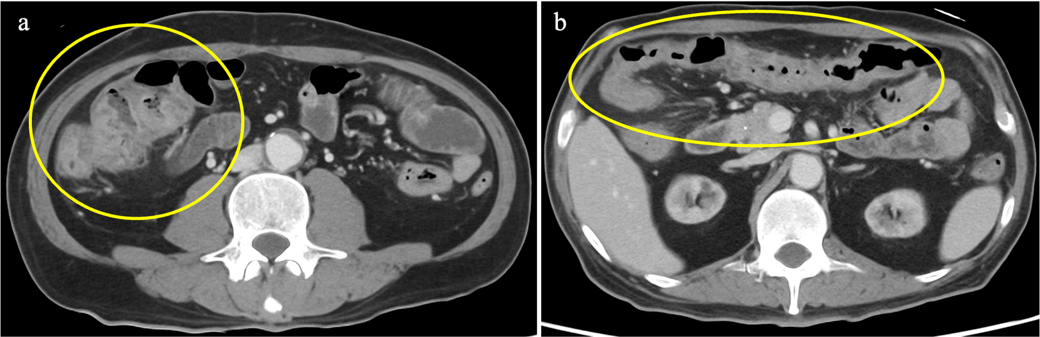 Gastrointestinal-localized polymorphic post-transplant lymphoproliferative disorder following kidney transplantation after allogeneic hematopoietic stem cell transplantation: a rare case report