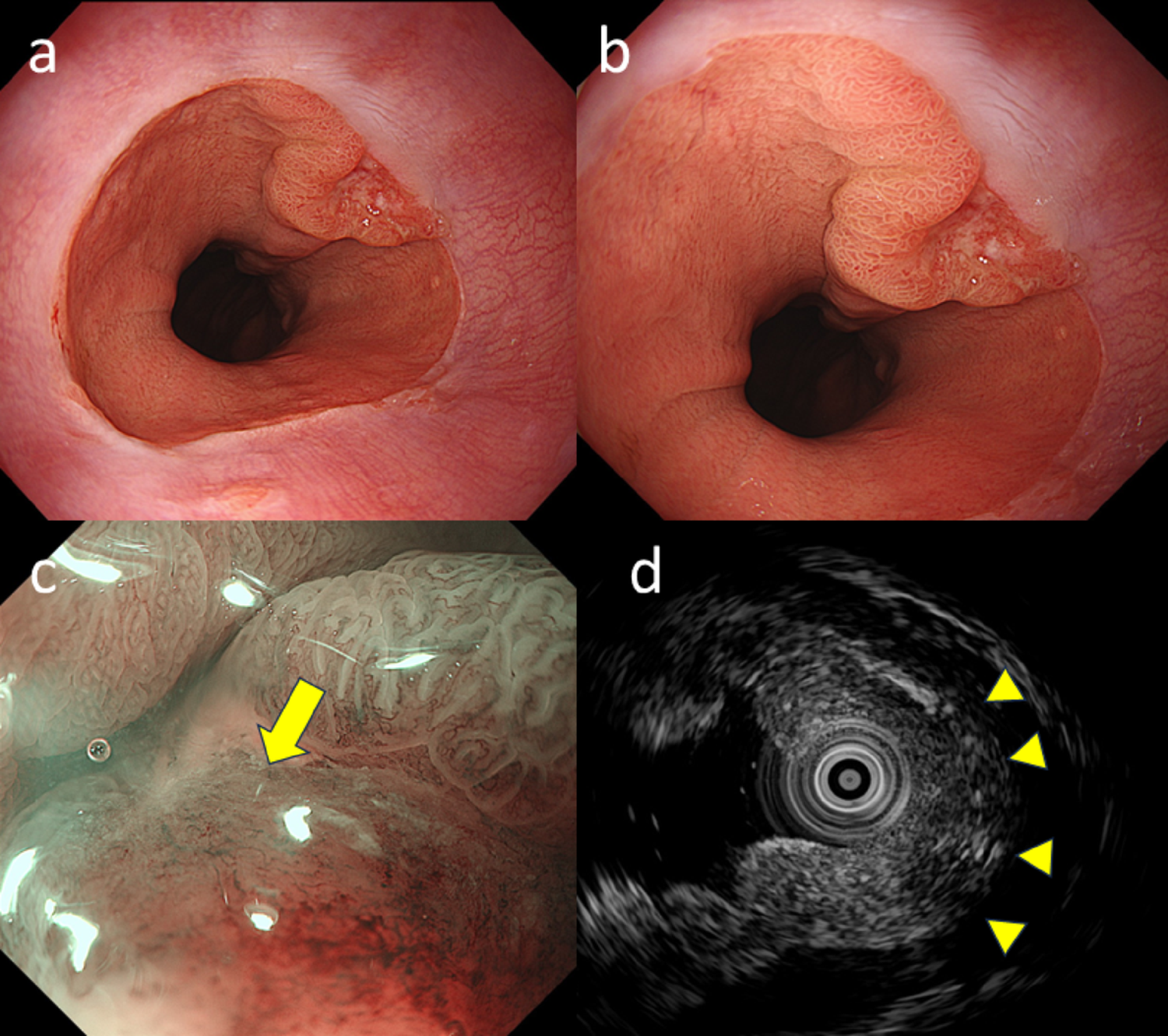 Endocrine carcinoma with amphicrine carcinoma component at esophagogastric junction