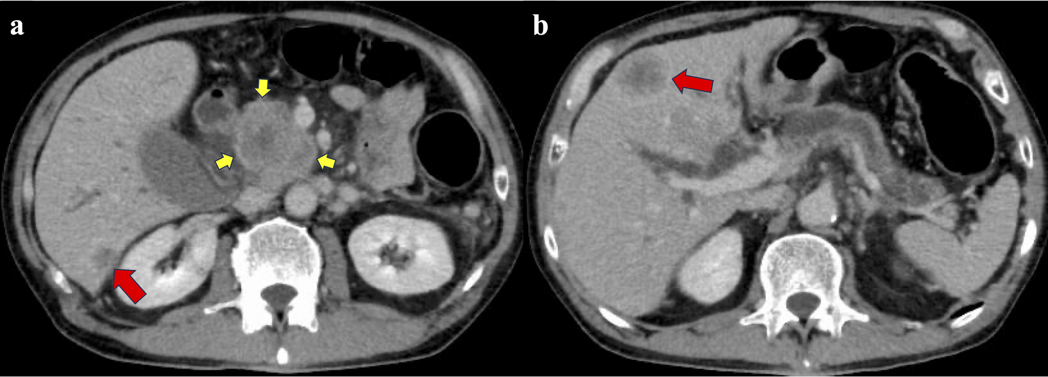 Long-term survival in a patient with -mutated pleomorphic anaplastic pancreatic carcinoma treated with Olaparib maintenance therapy