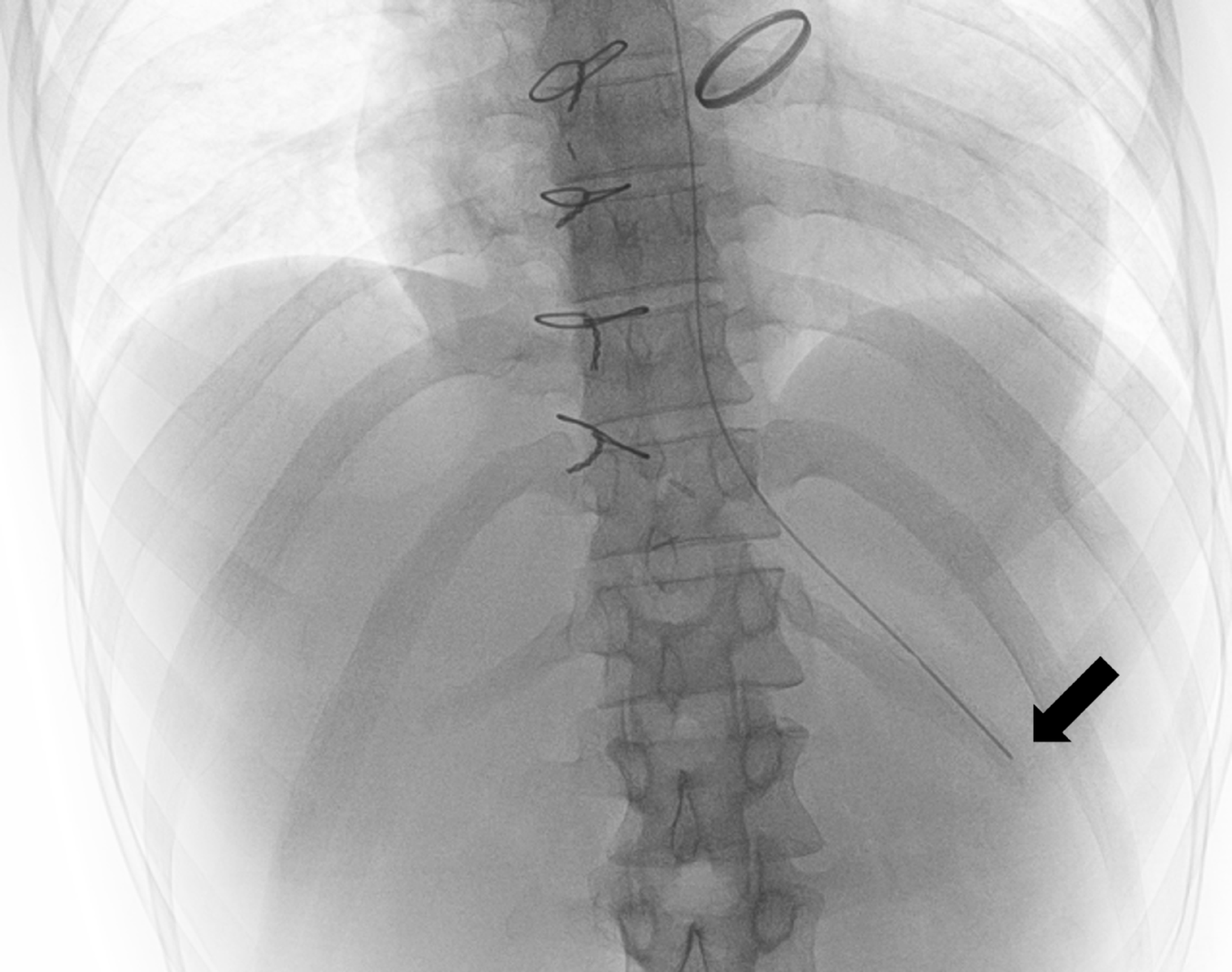 Esophageal bezoar formation following enteral nutrition
