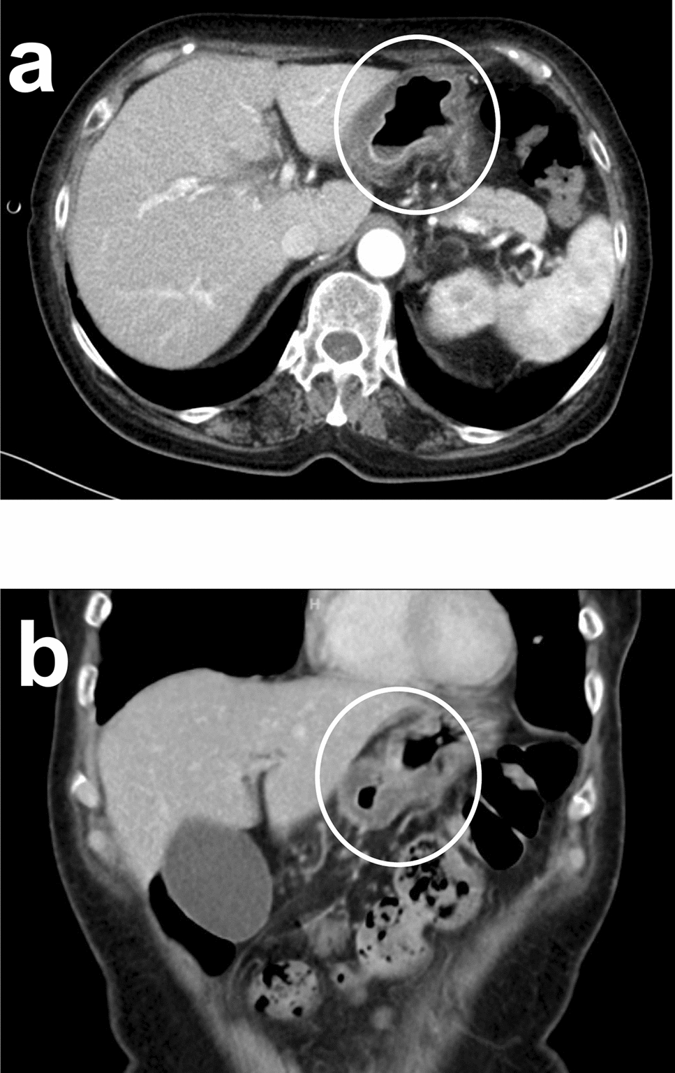 Cytomegalovirus gastritis following immune checkpoint inhibitor-associated gastritis induced by ipilimumab and nivolumab therapy in a patient with renal cell carcinoma