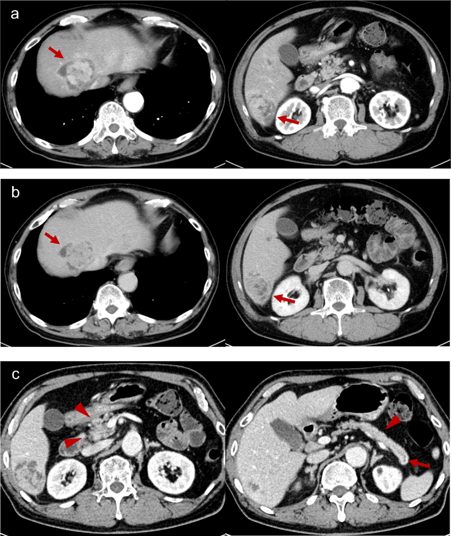 An autopsy case of multiple liver metastases from minute pancreatic acinar cell carcinoma clinically diagnosed as primary hepatic acinar cell carcinoma