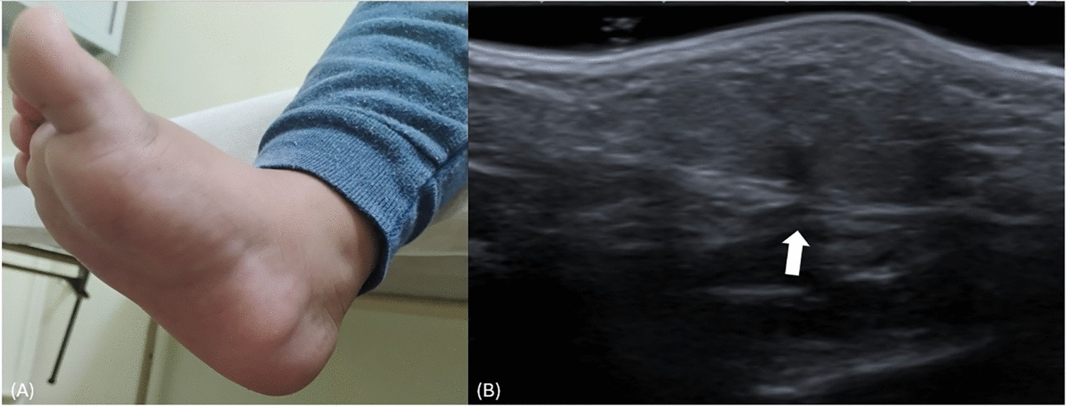 Bilateral precalcaneal congenital fibrolipomatous hamartoma