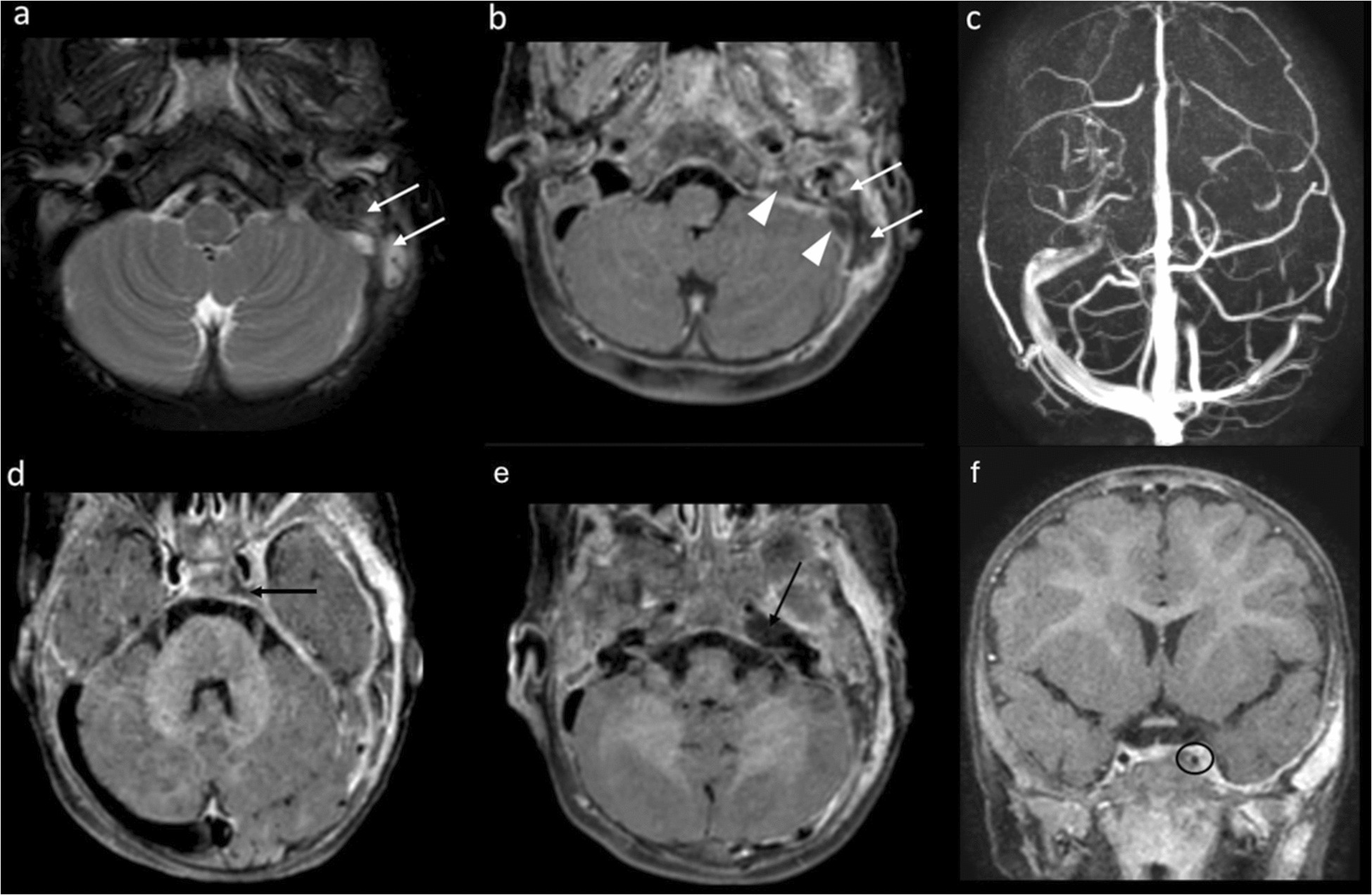 Internal carotid artery arteritis as a rare complication of pediatric otomastoiditis: serial magnetic resonance imaging and magnetic resonance angiography findings
