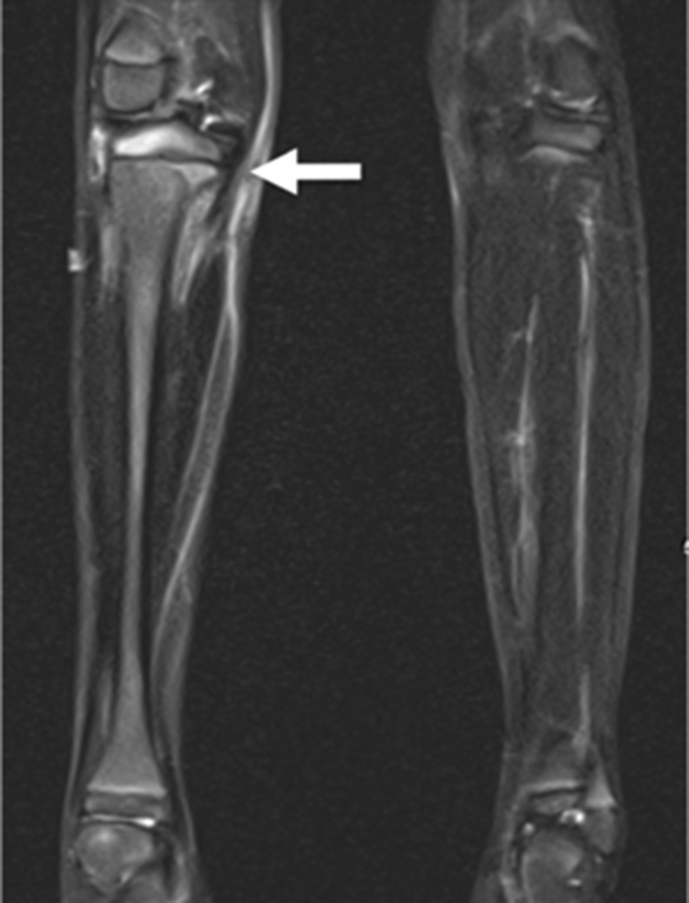 Streamlining pediatric musculoskeletal infection workup: the why, what, and how of rapid MRI protocols