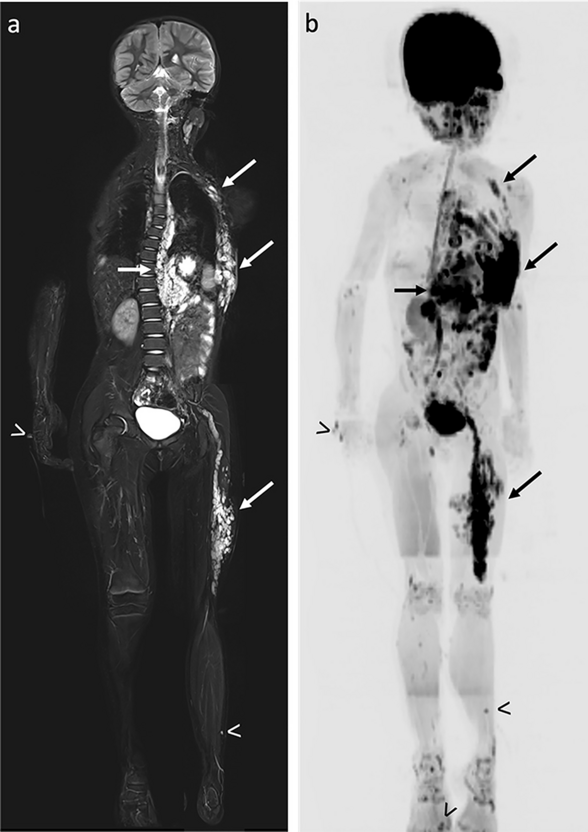 Whole-body magnetic resonance imaging mapping of plexiform neurofibromas