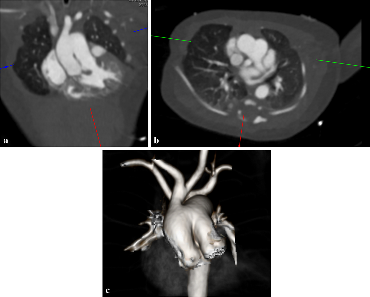 Aortopulmonary window