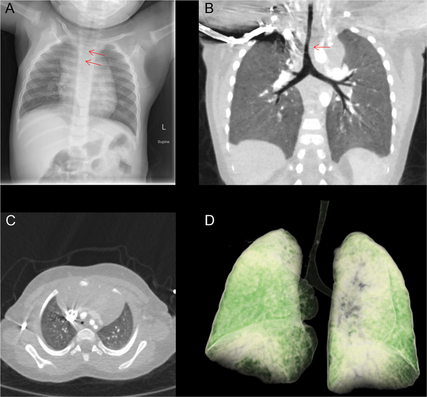 Idiopathic complete tracheal rings: an uncommon cause of congenital airway stenosis