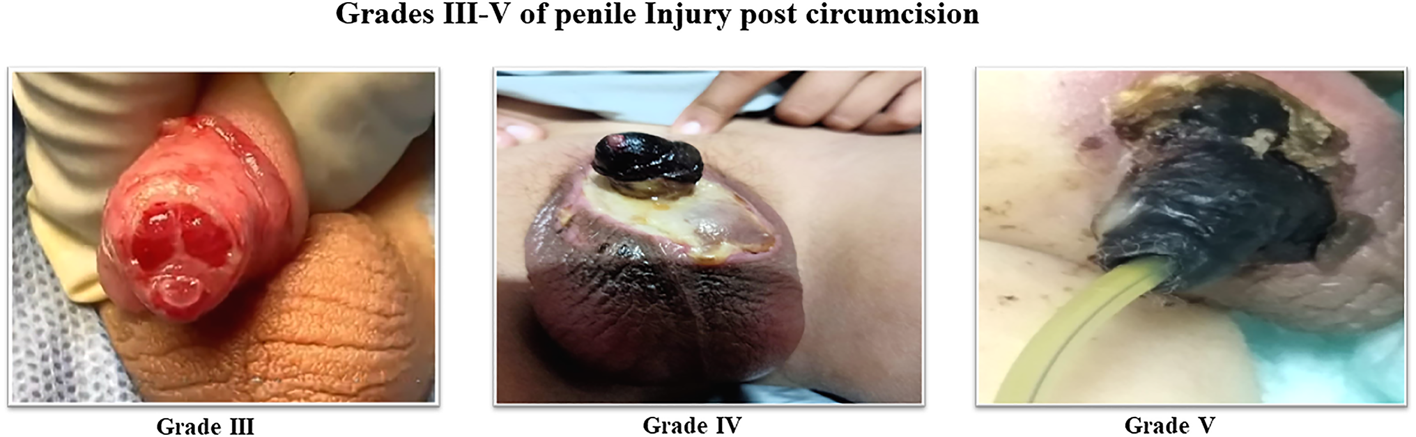 Reconstruction of high-grade post-circumcision penile injuries using fenestrated skin and oral mucosa grafts for glans resurfacing: a single-center experience