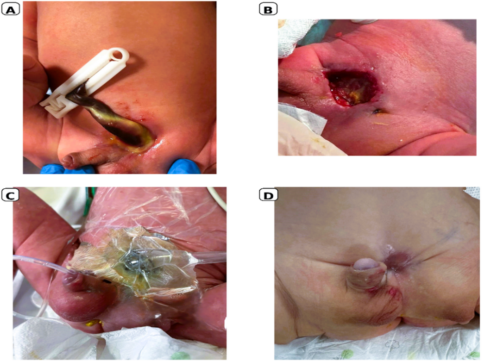 Negative pressure wound therapy in children: outcomes across a heterogeneous wound cohort