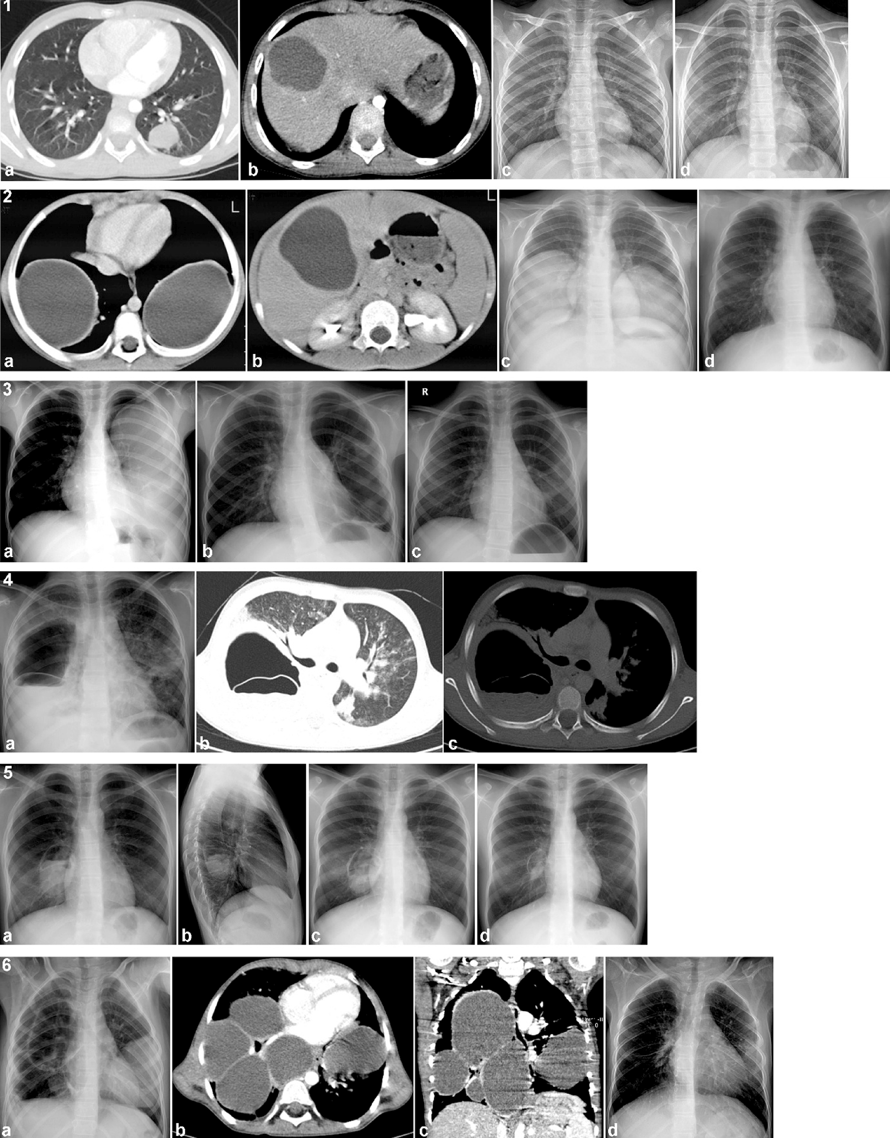 Surgical approach to lung hydatid cysts in children