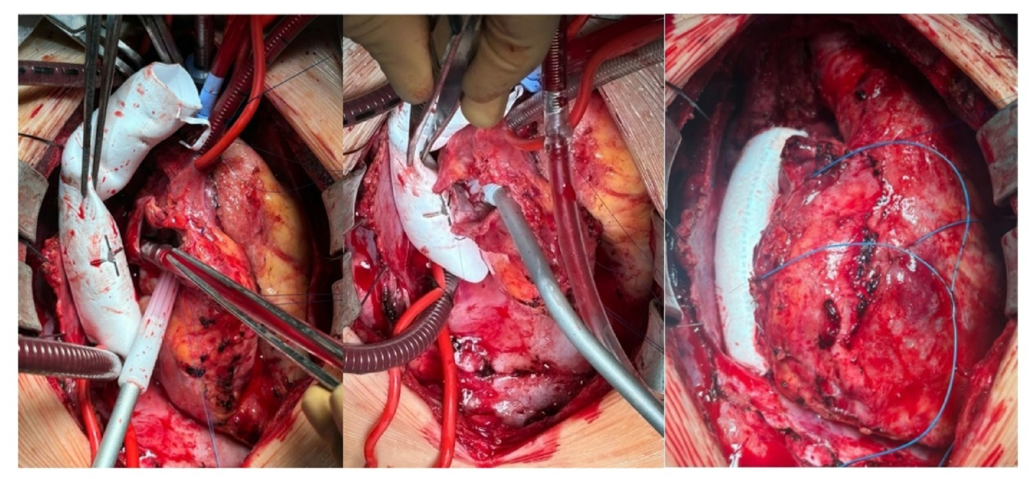 Extracardiac Fontan Operation with Prebuilt Fenestration: Preparing the Road for Future Atrial Access
