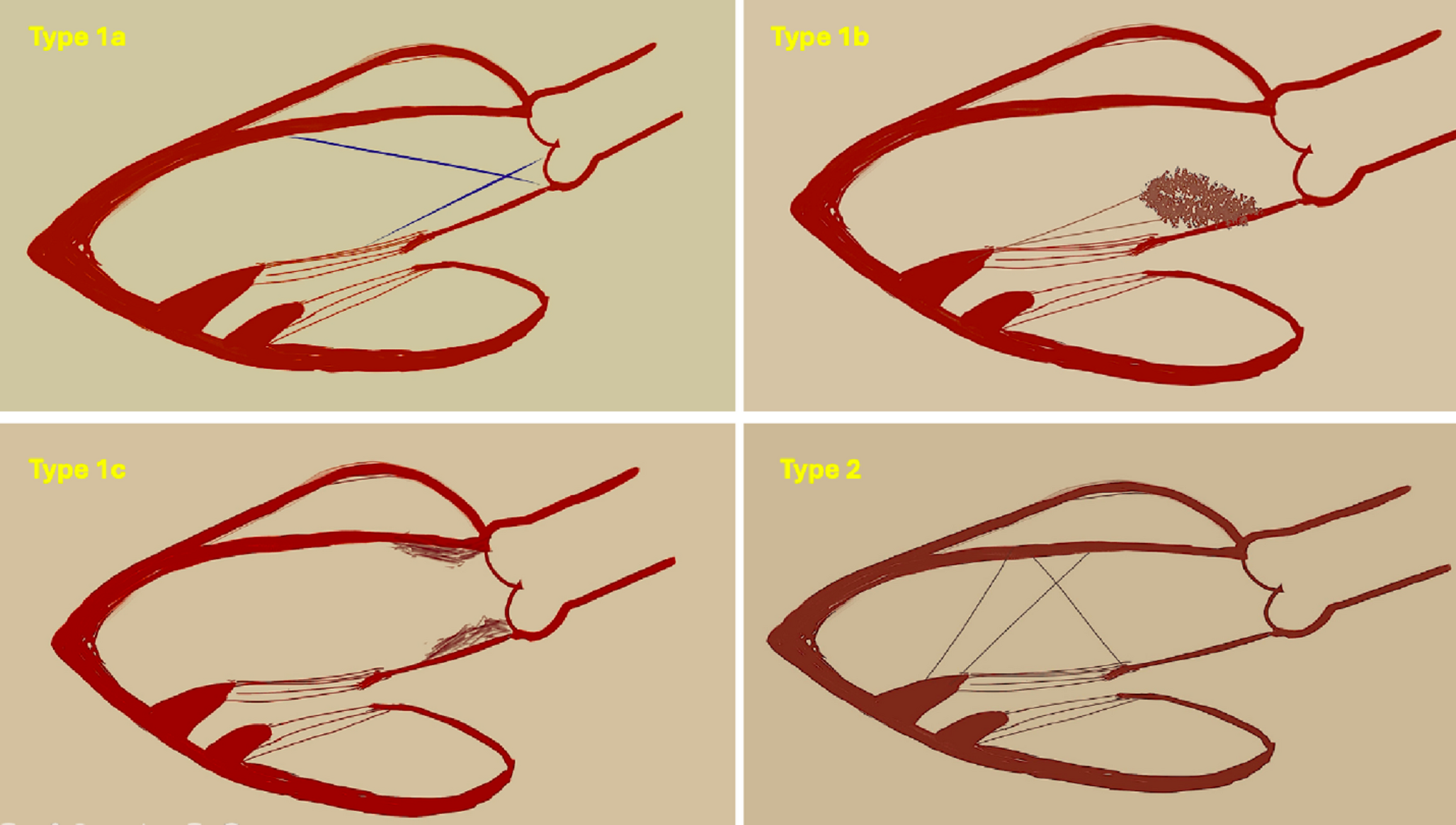 Accessory Mitral Valve Tissue: A 15-Year Single-Center Pediatric Experience