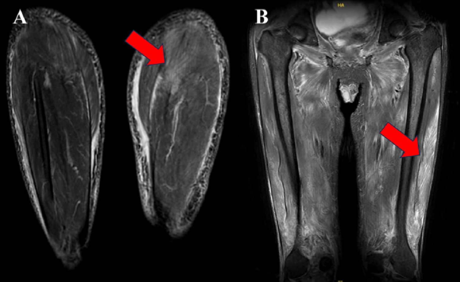 Correction: MRI-guided muscle biopsy improves diagnostic yield in small- to medium-vessel vasculitis: a retrospective single-center study