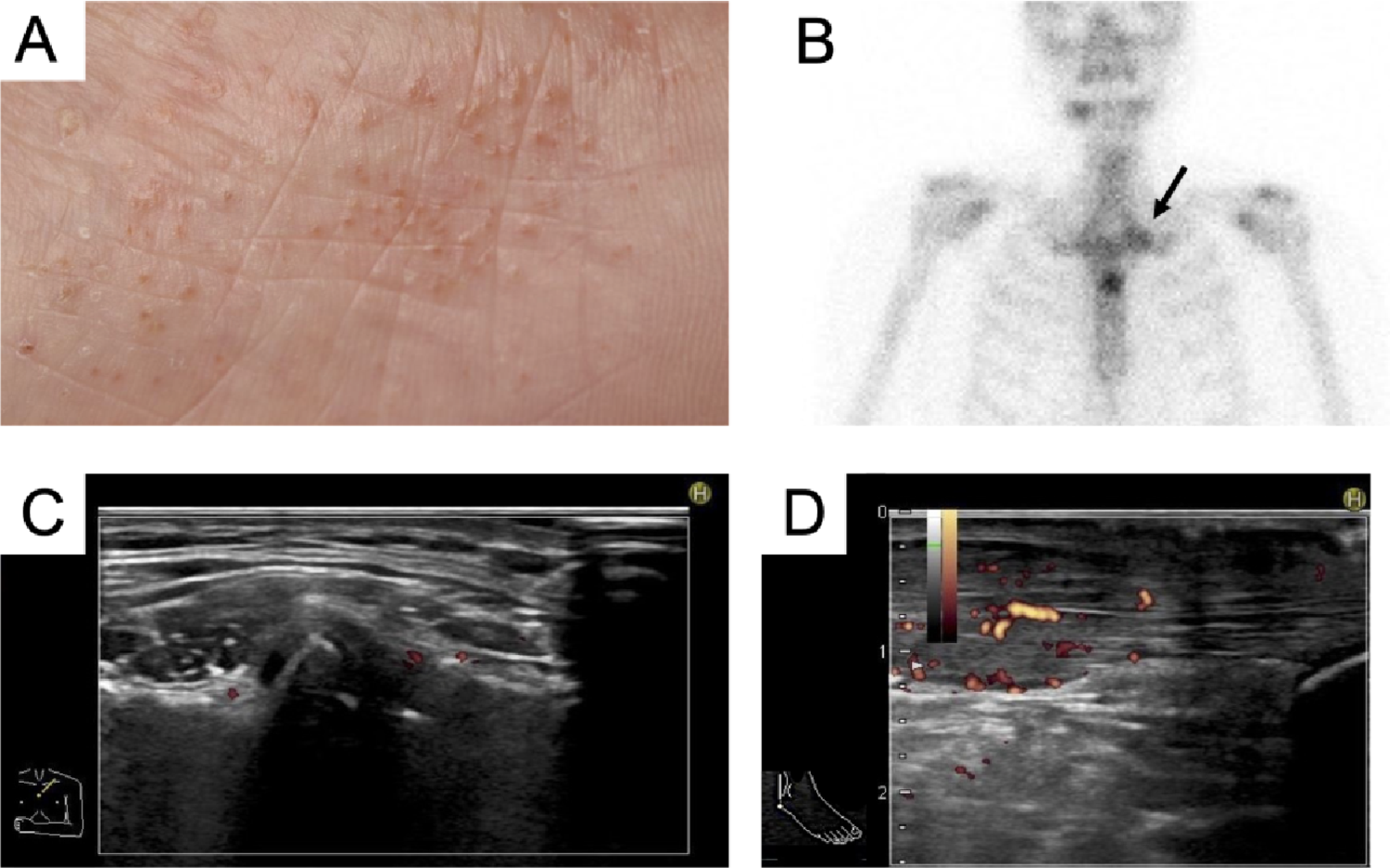 Behçet’s disease occurred after brodalumab initiation in a patient with chronic non-bacterial osteitis: a case-based literature review