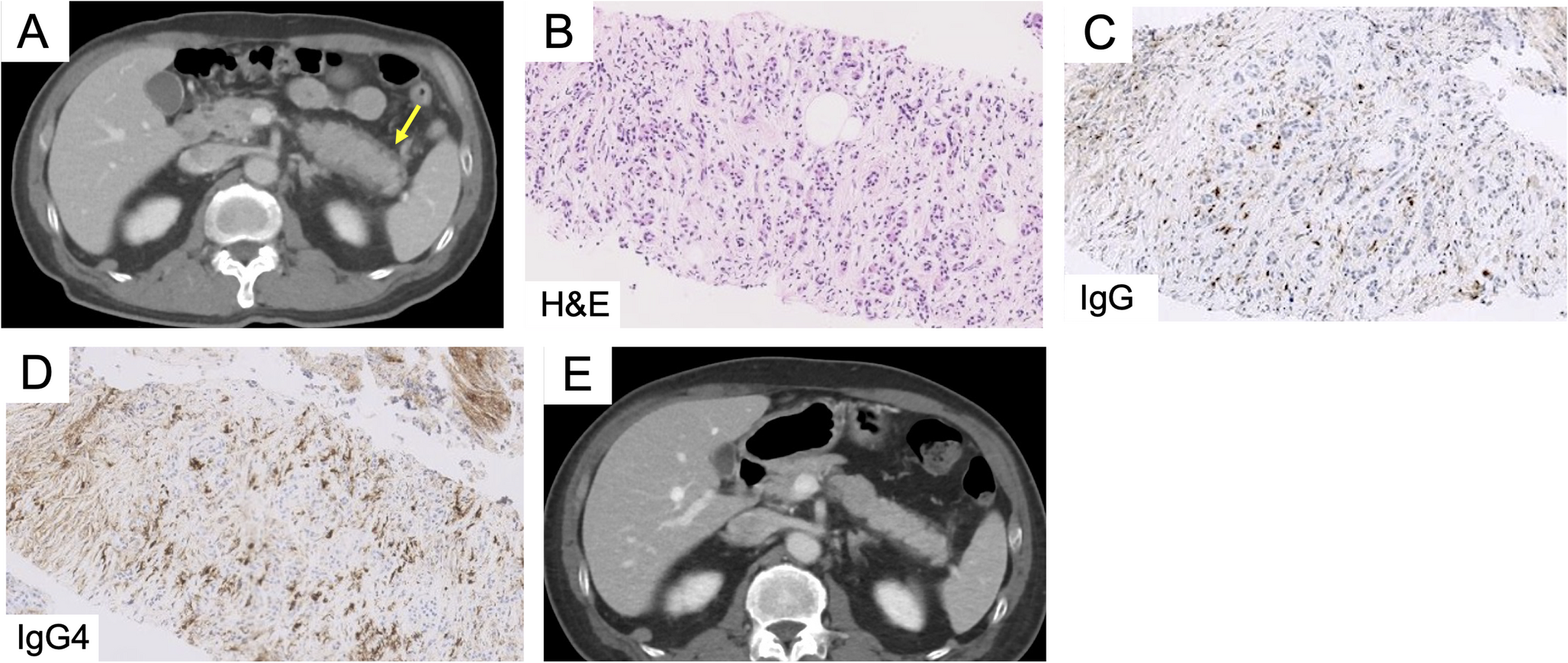 Simultaneous improvement of immunoglobulin G4–related disease complicated by nontuberculous mycobacteria infection by anti-infective therapy alone: a case-based literature review