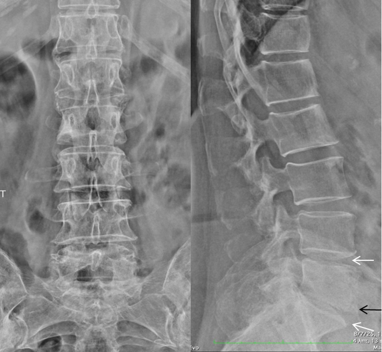 Late onset axial spondyloarthritis presenting with fever of unknown origin. A case-based review