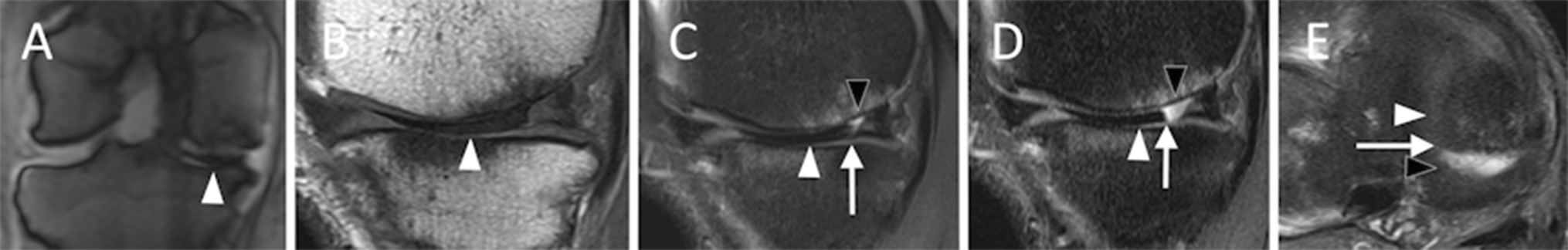 Intra-articular gas on knee MRI: a meniscal tear mimic and description of a novel MRI sign