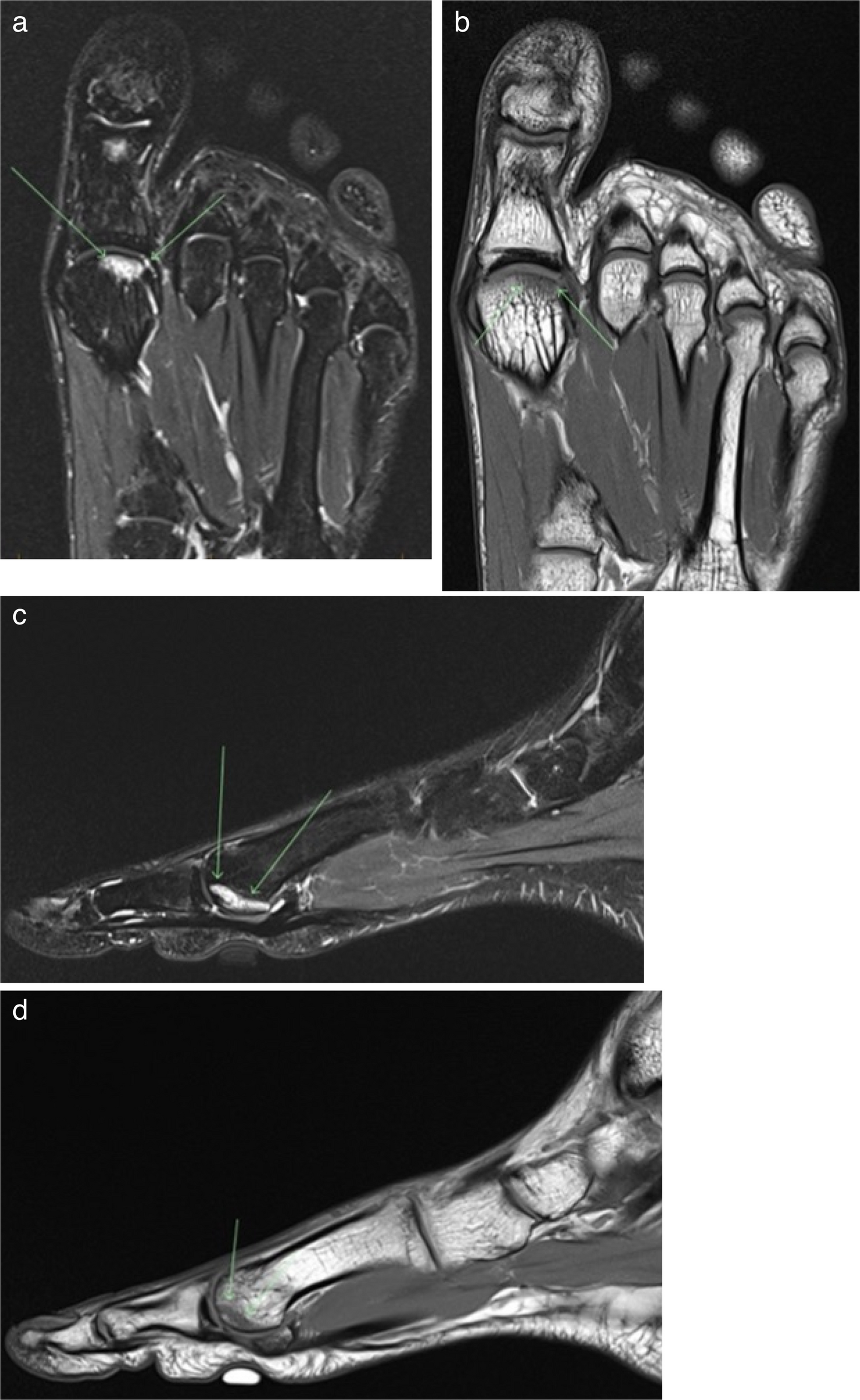 Osteonecrosis and stress-related subchondral injuries in the elite athlete: a review on etiology, clinical signs, and management