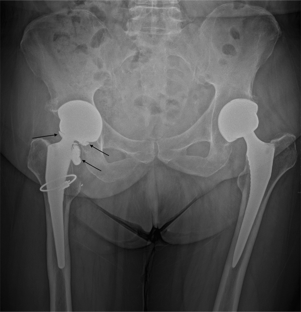 Late-onset atraumatic ceramic head fracture in a ceramic-on-ceramic total hip arthroplasty: a case report