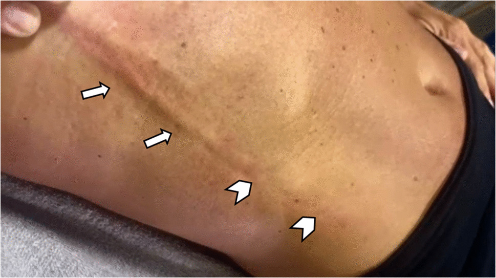 Anterior chest wall lesion
