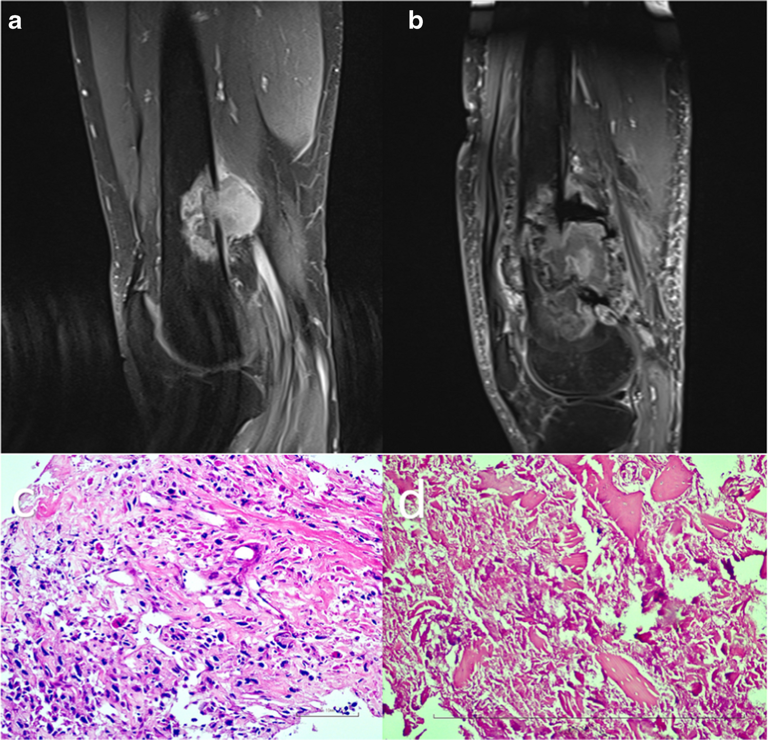 Pathologic fracture following neoadjuvant therapy: a paradoxical radiological sign of effective treatment response
