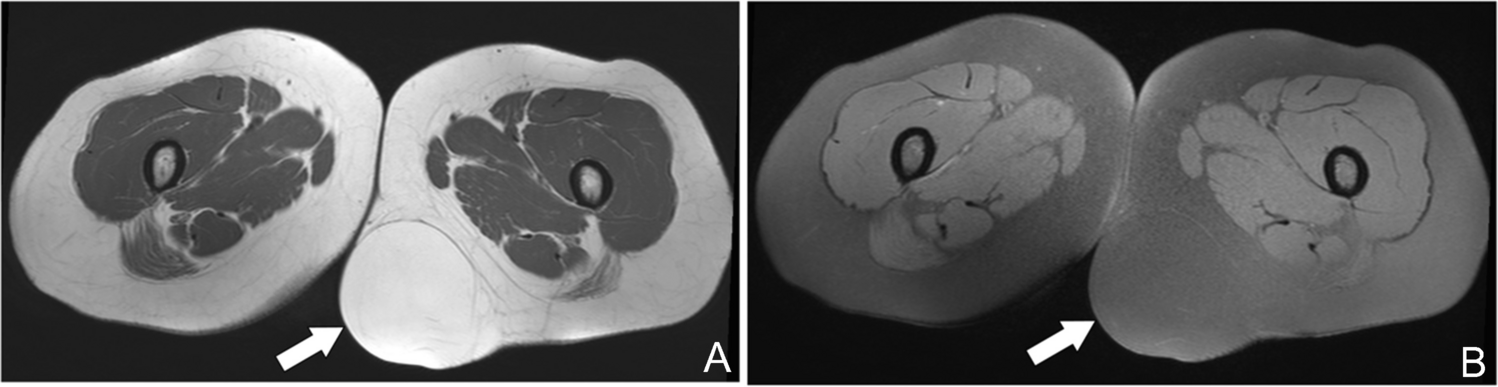 Fat-containing soft-tissue tumors: Imaging findings and pathologic correlation