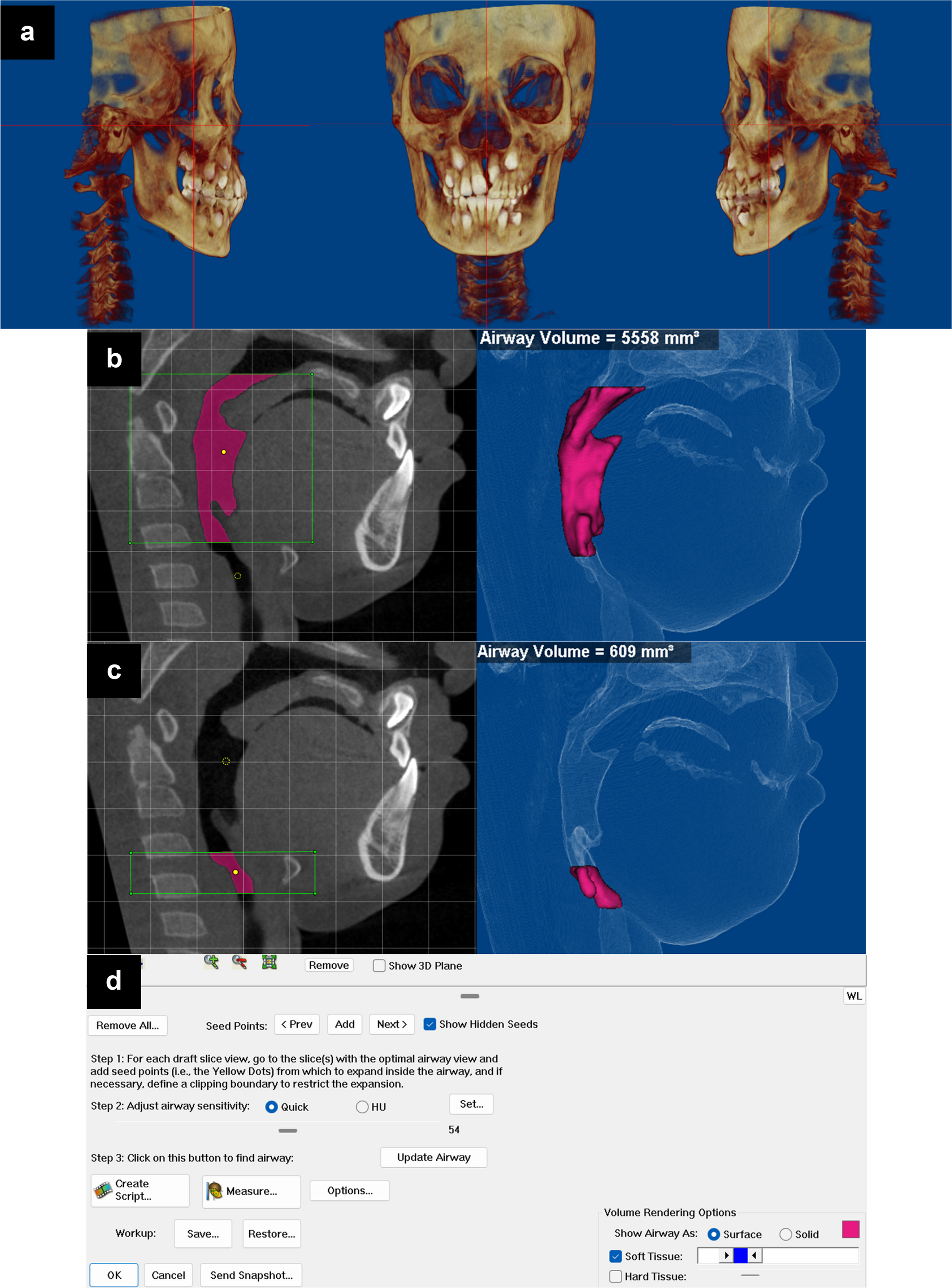 Investigating anatomical determinants of OSA in children with UCLP: insights into tongue, airway, and hyoid bone