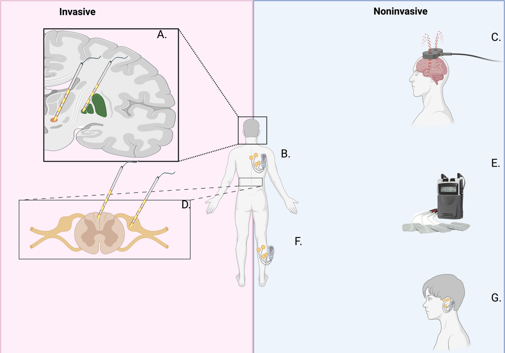Neuromodulation for Restless Legs Syndrome: A Systematic Review and Mechanistic Considerations for Spinal Cord Stimulation