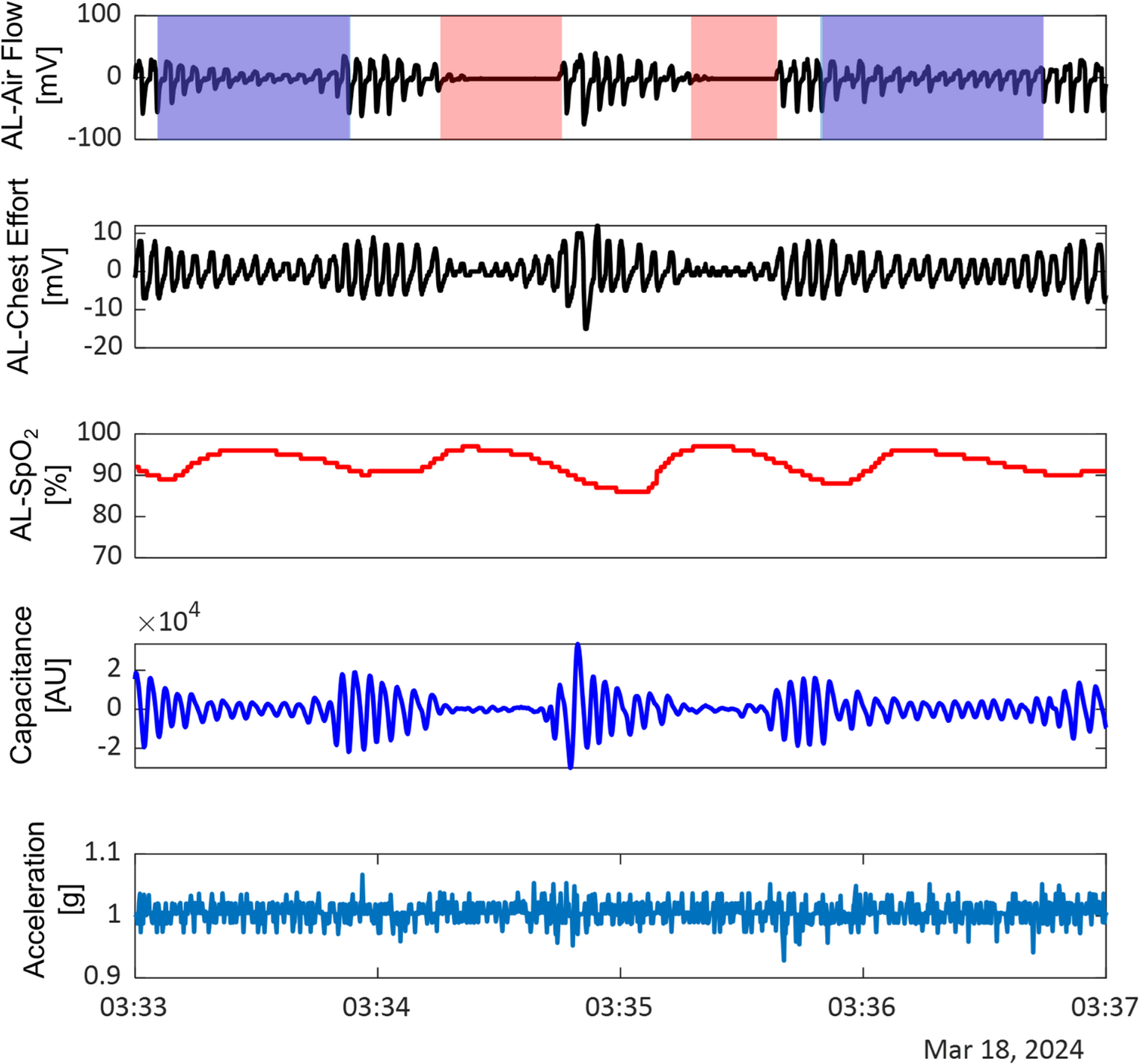 Detection of apnea and hypopnea events using a wireless Abdomen-Worn sensor with SpO₂ integration