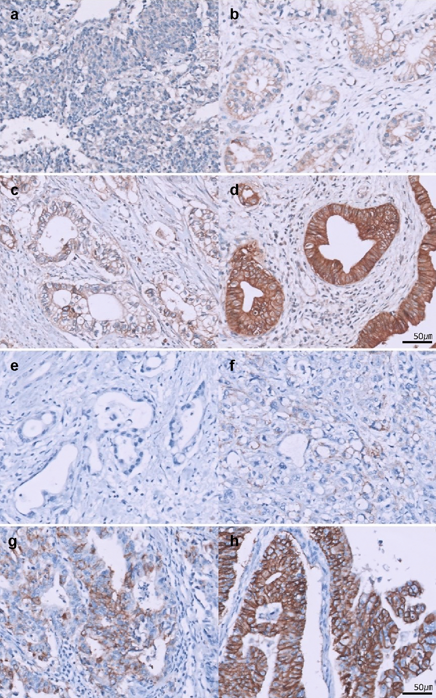 Claudin-18.2 and Trop-2 as Emerging Biomarkers in Biliary Tract Cancers: Expression Analysis and Therapeutic Potential